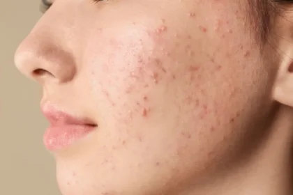 how to remove pimples overnight
