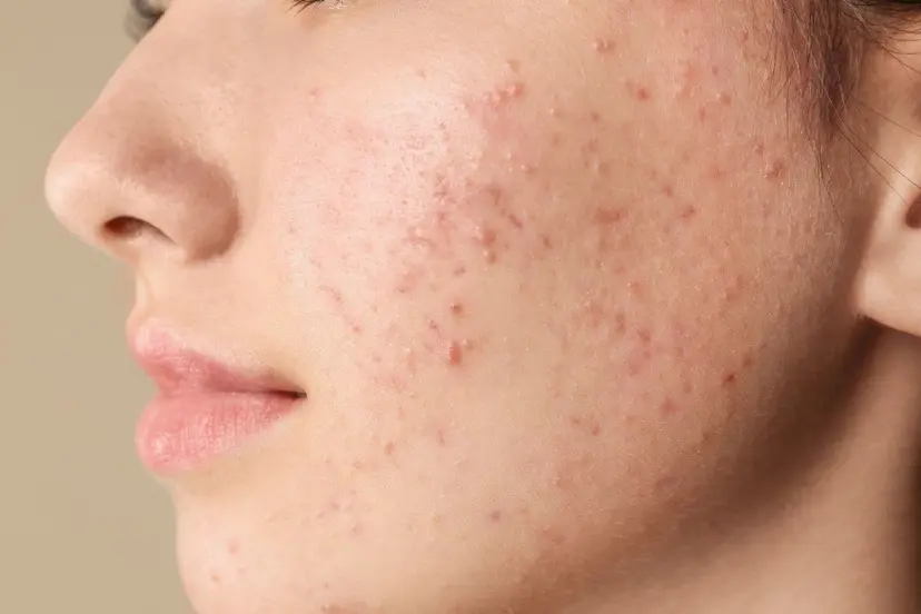 how to remove pimples overnight