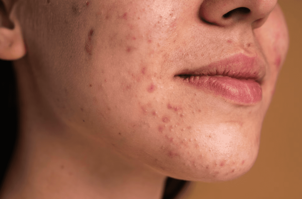 Almond milk cause Acne