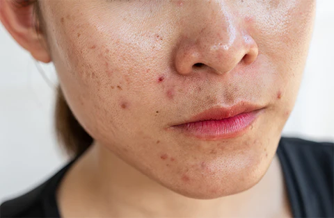 damaged skin